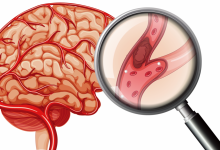 年纪大了怕高血压致脑梗?这些误区和忌口一定要避开 - 大风热搜网