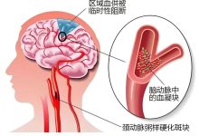 退休阿姨频繁忘事、走路发飘？别当老糊涂！这是脑血管变硬的4个预警 - 大风热搜网