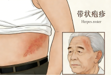 仲春警惕带状疱疹！这份超全科普，看懂病因、高危人群与防护法 - 大风热搜网